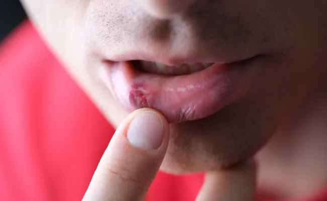 Herpes